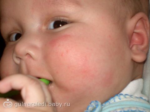 Аллергия на пыль. Симптомы и профилактика Аллергия у грудного ребенка: как ее лечить?