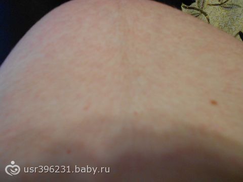 Зуд по всему телу. без высыпаний беременность Зуд по всему телу. без высыпаний беременность