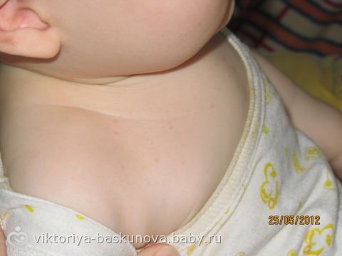 У ребенка мелкая сыпь на грудной клетке У ребенка мелкая сыпь на грудной клетке