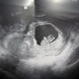 Фотографии УЗИ на 8-й неделе беременности