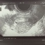 Фотографии УЗИ на 5-й неделе беременности