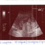 Фотографии УЗИ на 13-й неделе беременности
