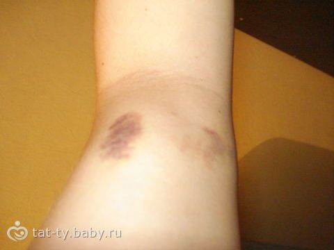 Варикоз язвы на ногах лечение