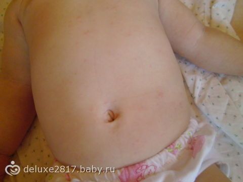 Сыпь?