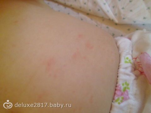 Сыпь?